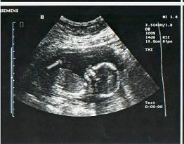 pregnancy-ultrasound-17-weeks.jpg
